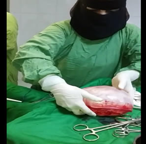 استئصال ورم يزن ثلاثة كيلو من رحم امرأة بمستشفى زايد بأمانة العاصمة