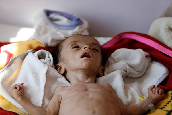 Yemeni children suffer from acute malnutrition