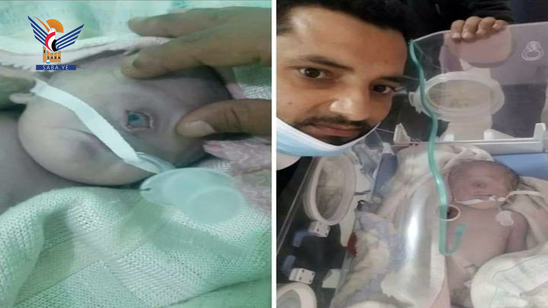 Yemeni woman gives birth to baby with one eye for using forbidden weapons by aggression