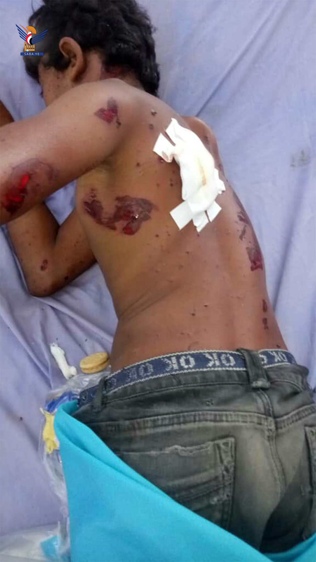 Deux enfants ont été blessés dans l'explosion d'un vestige de l'agression dans le district d'Al-Hali à Al-Hodeidah