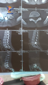 Extracting a gunshot from spinal cord of a girl in Republican Hospital in Hajjah