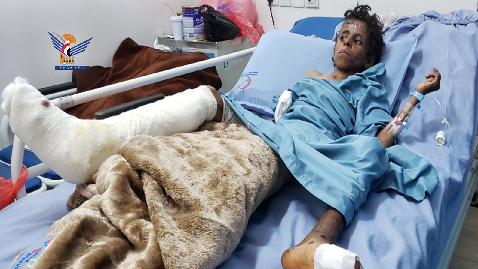 Verwundung von 2 Kindern in Hodeidah durch  Explosion einer Aggressionsmine