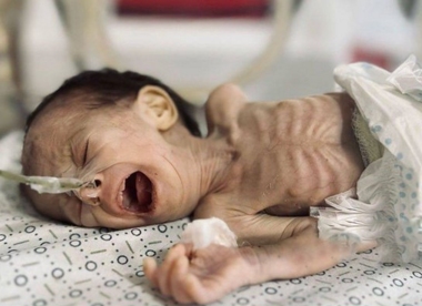 Inmitten internationaler Warnungen tötet Unterernährung die Kinder in Gaza aufgrund der zionistischen Hungersnot