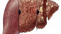 الكشف عن الأعراض الأولى لسرطان الكبد
