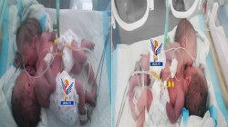 فريق طبي بمستشفى السبعين ينجح في إجراء عملية ولادة قيصرية لتوأم سيامي ملتصق