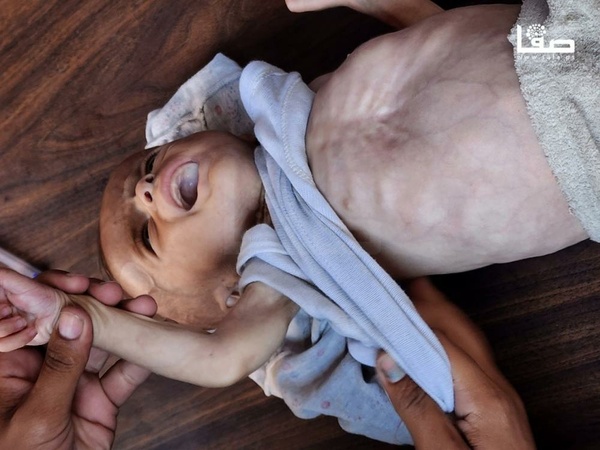 Al-Shifa Medical Complex in Gaza: We Recorded 7 Deaths Due to Malnutrition Al-Shifa Medical Complex in Gaza: We Recorded 7 Deaths Due to Malnutrition