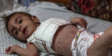 Gaza Media Office: 1.8 million cases in Gaza due to displacement and lack of health service