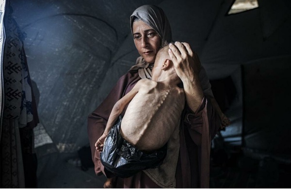 Medical Relief in Gaza: 17,000 children in Gaza suffer from severe malnutrition Medical Relief in Gaza: 17,000 children in Gaza suffer from severe malnutrition