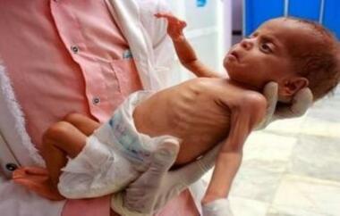 La Salud en Gaza: 60.000 niños corren el riesgo de sufrir graves complicaciones de salud debido a la desnutrición