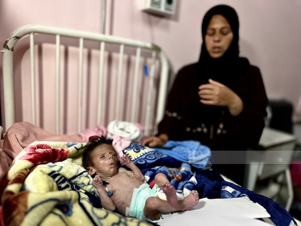Hunger, malnutrition kill more people in Gaza Hunger, malnutrition kill more people in Gaza