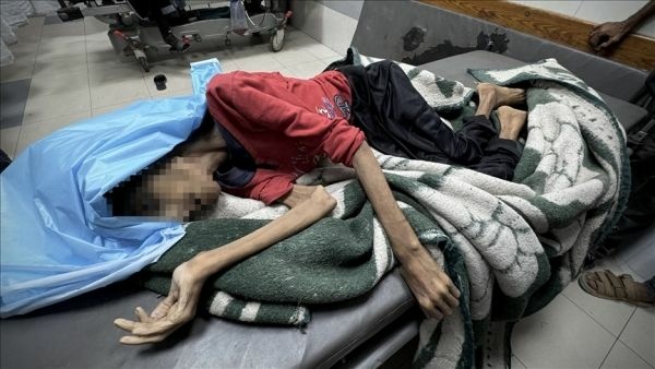 Palestinian Ministry of Health: 6 new deaths due to famine, malnutrition Palestinian Ministry of Health: 6 new deaths due to famine, malnutrition